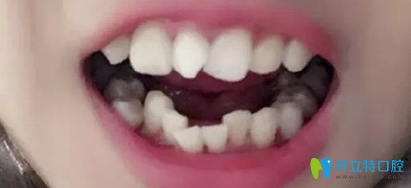 沒有戴牙套前牙齒的照片