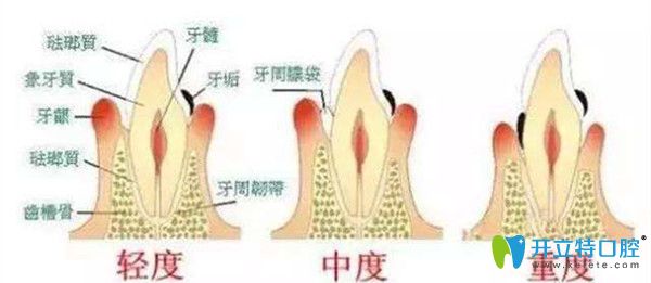牙齦萎縮的三種情況