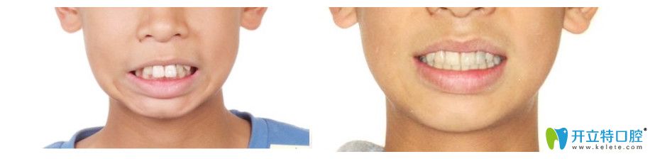 重慶牙博士口腔全隱形矯正對比
