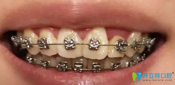 金屬托槽矯正前后對(duì)比圖