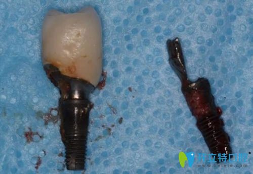 種植牙失敗的原因