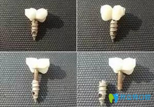 種植牙維護(hù)不好會(huì)導(dǎo)致使用時(shí)間減短