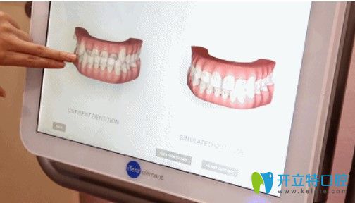 好佰年口腔矯正黑科技iTero