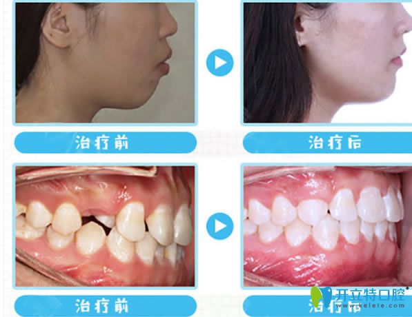 <!--<i data=20240703-sp></i>-->成人隱適美矯正案例對比圖