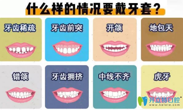 地包天和深覆合等情況需要做牙齒矯正