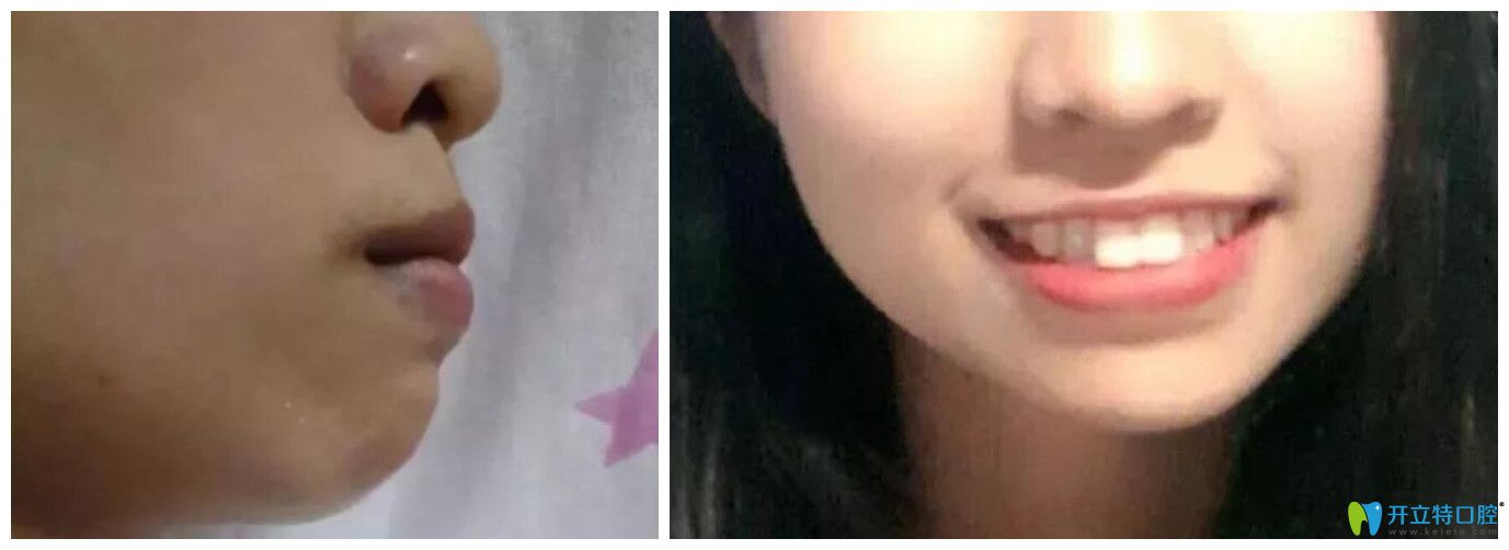 門牙前突在西安藝星做矯正22個月，下牙套后臉型變化很大