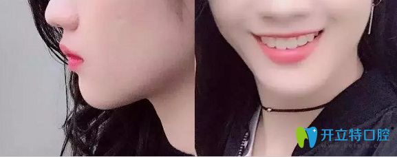 威海舒好口腔牙齒不齊擁擠矯正術(shù)后照 威海舒好口腔牙齒不齊擁擠矯正術(shù)后照