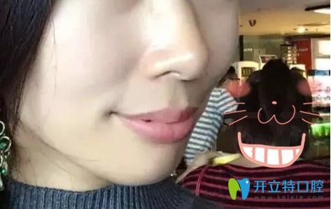 做齙牙矯正拔牙后戴牙套3個(gè)月的樣子