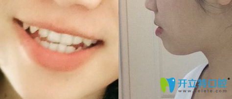 <!--<i data=20240703-sp></i>-->圣康口腔地包天牙齒矯正術(shù)前照