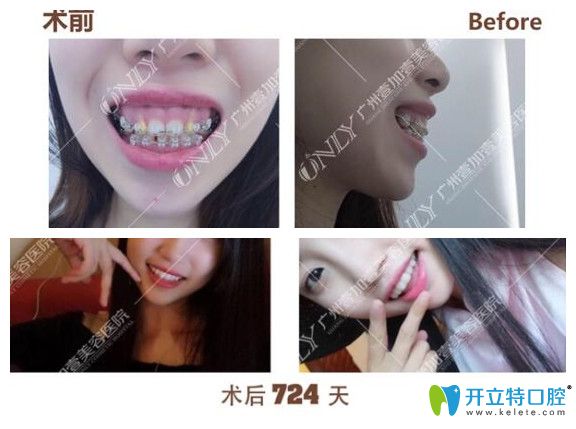 廣州壹加壹口腔露齦笑矯正前后臉型變化圖效果對比