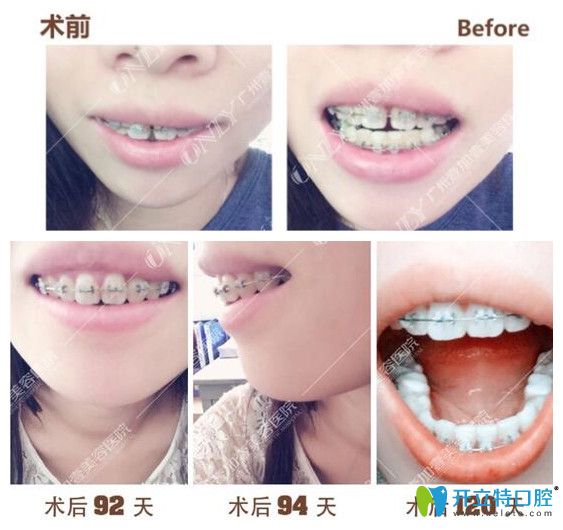 壹加壹齙牙，門牙縫隙矯正過程中牙齒變化圖