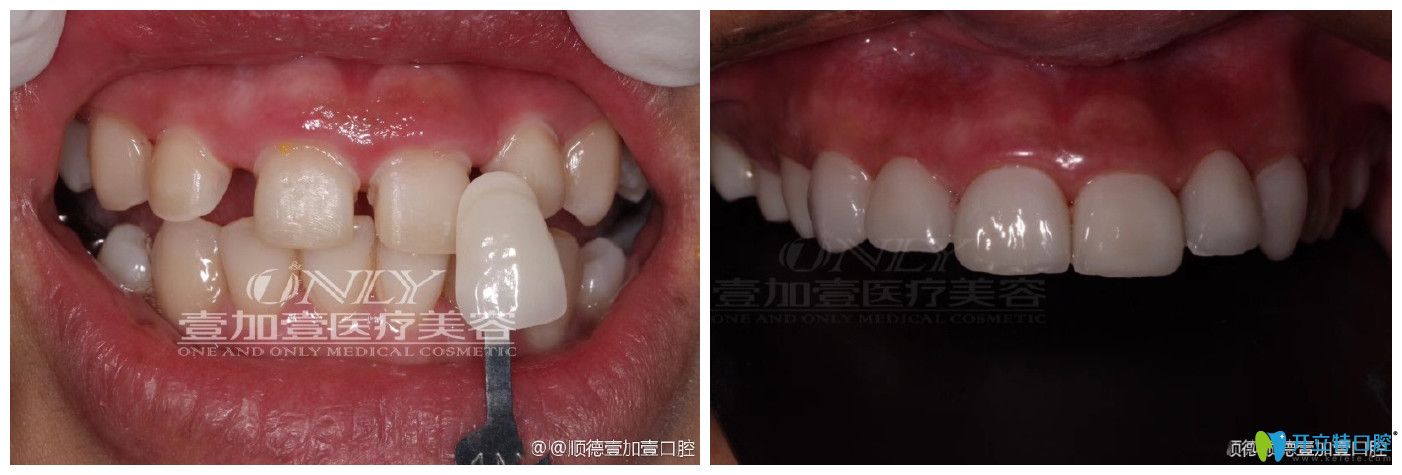 佛山順德壹加壹口腔牙貼面修復(fù)牙齒縫隙大案例前后效果對(duì)比