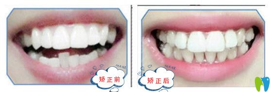 清遠(yuǎn)中大時(shí)代天使隱形矯正前后圖