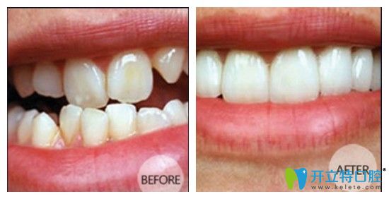 清遠(yuǎn)中大口腔金屬托槽矯正前后圖