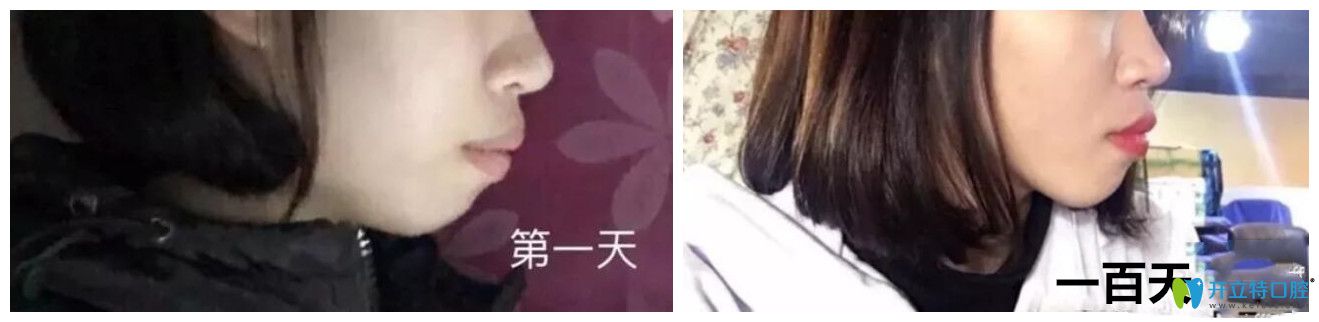牙齒矯正過程中側(cè)臉變化圖