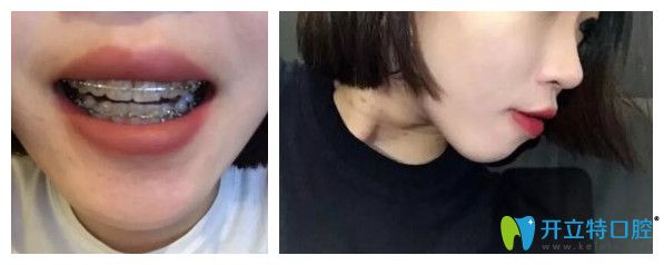 義烏傅氏口腔牙齒矯正收縫階段