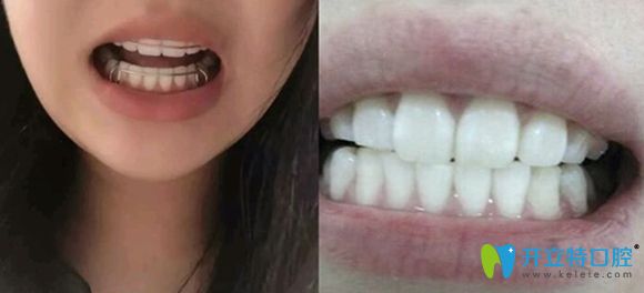 濟南韓氏口腔金屬牙套矯正術后效果很贊 濟南韓氏口腔金屬牙套矯正術后效果很贊