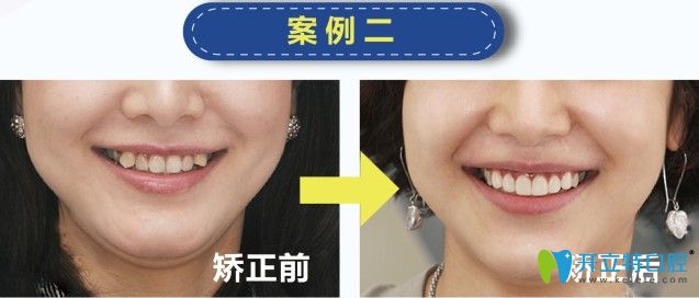 歡樂仁愛口腔虎牙矯正案例 歡樂仁愛口腔虎牙矯正案例