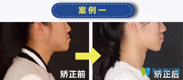 歡樂仁愛口腔地包天矯正案例 歡樂仁愛口腔地包天矯正案例