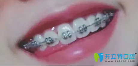 珠海九龍口腔做金屬牙套矯正一年效果圖