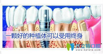 韓國登騰種植體壽命是多少年