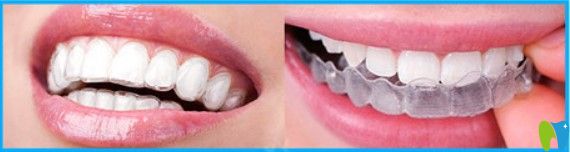 廣州壹加壹口腔全隱形牙齒矯正圖