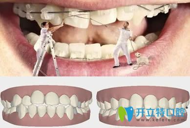  巫強(qiáng)平主任科普成人正畸與兒童正畸有什么區(qū)別