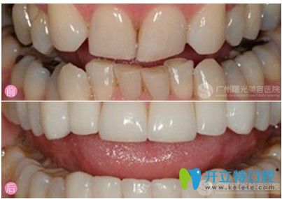 廣州曙光口腔牙齒不齊矯治案例