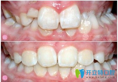 廣州曙光口腔齙牙矯治案例