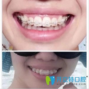 在東莞壹加壹口腔做陶瓷半隱形牙齒矯正術(shù)中照 在東莞壹加壹口腔做陶瓷半隱形牙齒矯正術(shù)中照