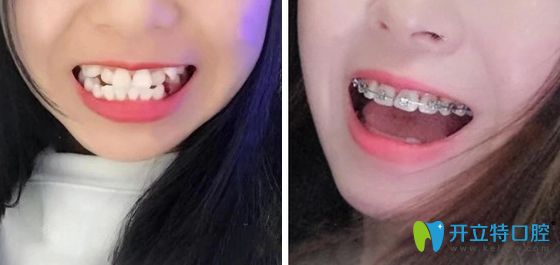 東莞壹加壹口腔牙齒正畸前后效果對比圖