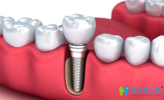 義烏傅氏口腔孫志群醫(yī)生科普：種植牙壽命的壽命有多久