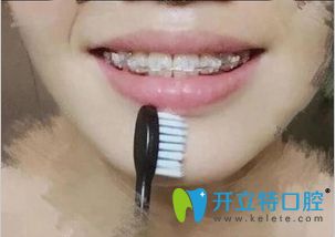 在東莞壹加壹口腔做陶瓷托槽矯正牙齒11個(gè)月效果 在東莞壹加壹口腔做陶瓷托槽矯正牙齒11個(gè)月效果