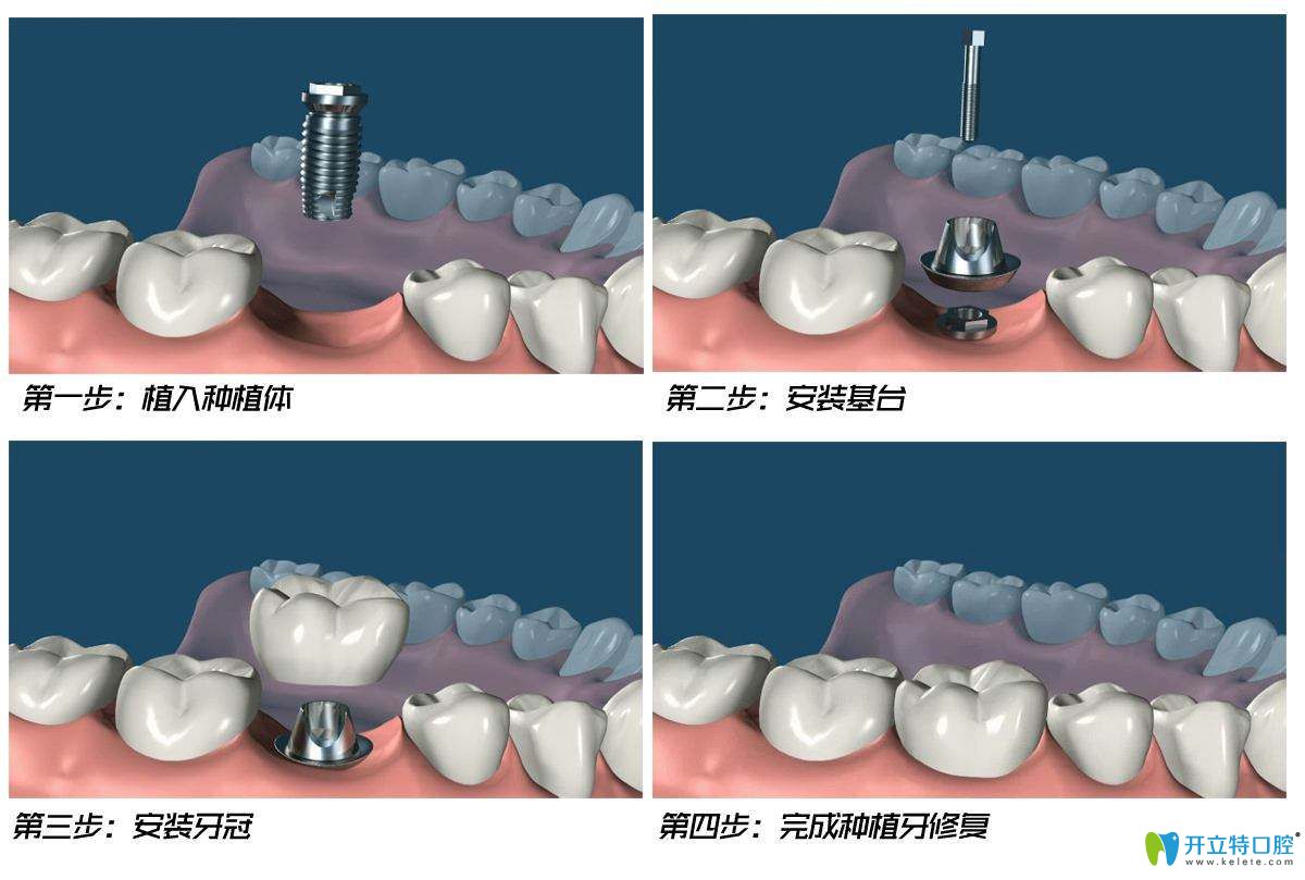 南昌輝煌口腔羅旋介紹種植牙知識(shí) 南昌輝煌口腔羅旋介紹種植牙知識(shí)