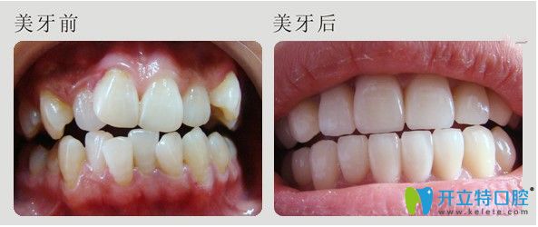成都圣貝口腔牙齒不齊矯正案例