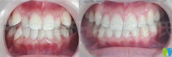 濟(jì)南韓氏口腔隱形牙齒矯正案例效果圖