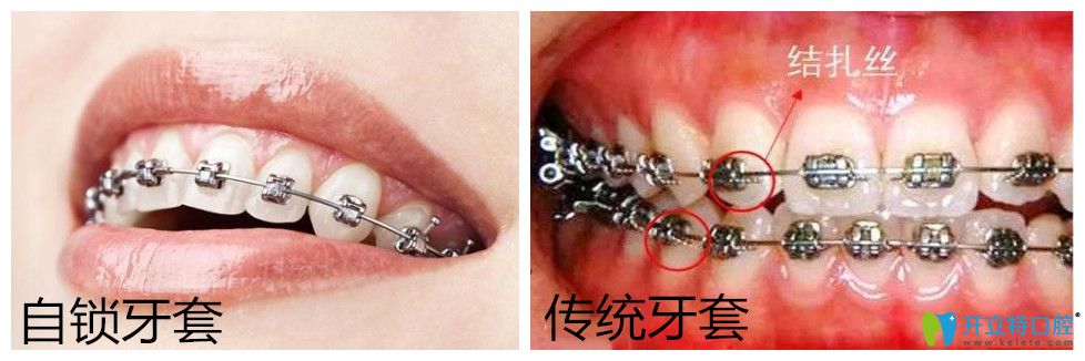 自鎖托槽牙齒矯正多少錢？正畸國產(chǎn)與進口自鎖有區(qū)別嗎?