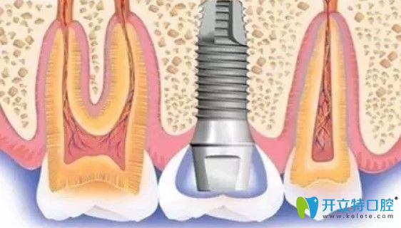北京維樂口腔種植體圖示