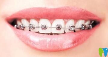 南昌輝煌口腔劉梅分享自鎖托槽牙齒矯正優(yōu)勢 南昌輝煌口腔劉梅分享自鎖托槽牙齒矯正優(yōu)勢