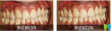 格倫菲爾牙齒擁擠矯正圖