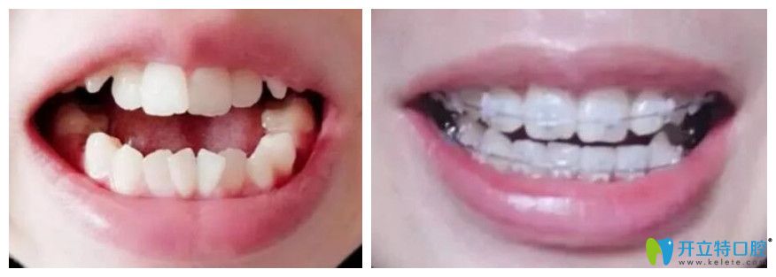 牙齒擁擠做陶瓷托槽矯效果
