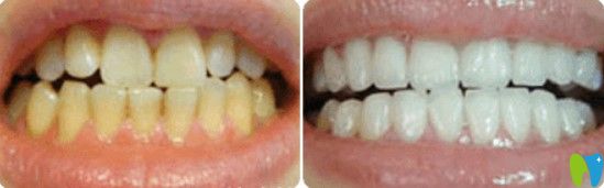 格倫菲爾牙齒發(fā)黃美白圖