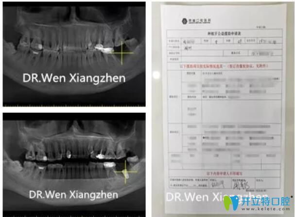 鼎植口腔種植牙案例前后對比圖