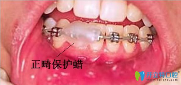 使用正畸蠟的注意事項介紹