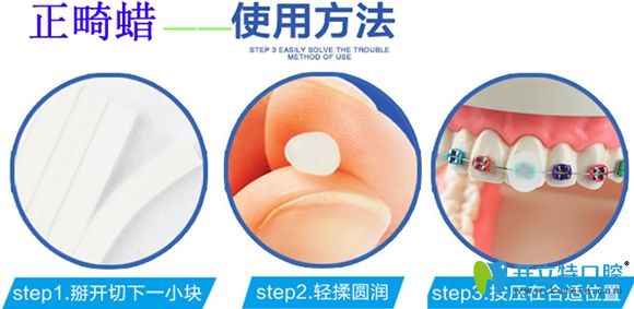 正畸保護蠟的使用方法圖解