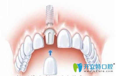 珠海仁愛口腔江榮強介紹種植牙術(shù)后注意事項