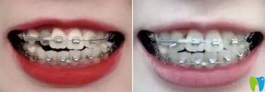 我在珠海仁愛口腔做牙齒矯正第7和第7個月