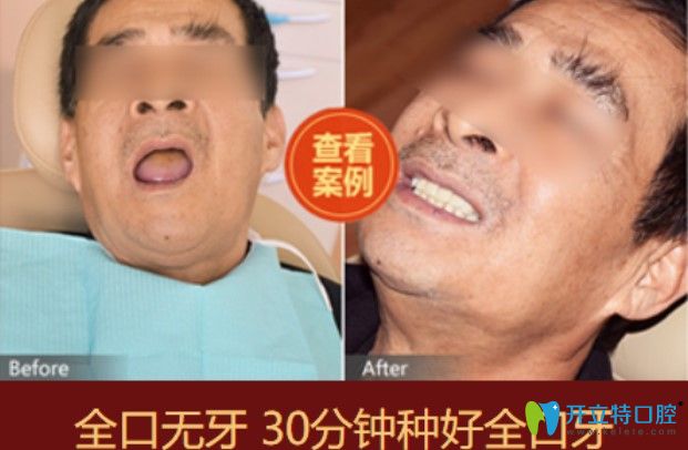 長(zhǎng)沙中諾全口種植案例圖示