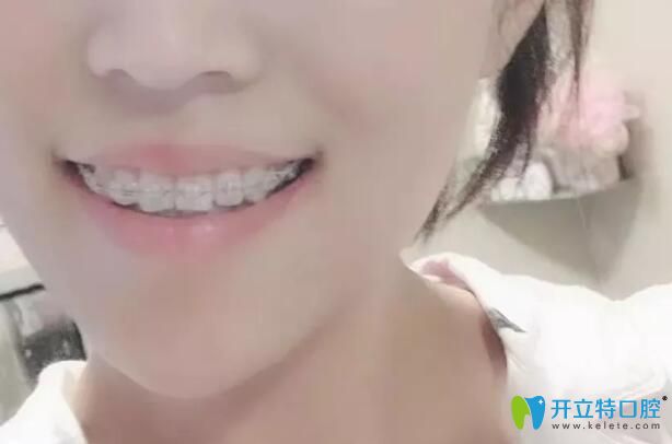 陶瓷半隱形矯正牙齒中期照片