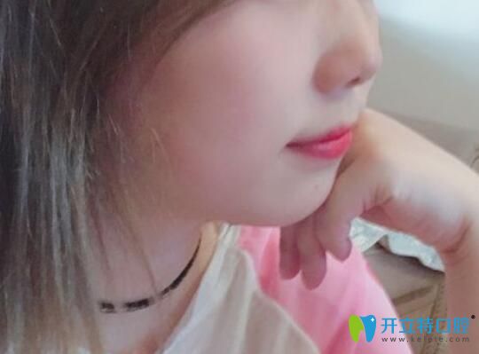 鄭州拜博口腔齊鵬飛給我做牙齒矯正2年